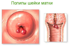 Как лечить полип цервикального канала во время беременности?