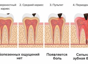 Современные методы лечения пульпита под пломбой: ключ к здоровью зубов