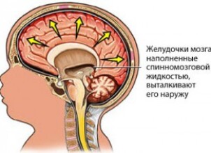 Противостоим гидроцефалии головного мозга у детей