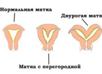 Двурогая матка: можно ли забеременеть при такой патологии?