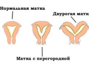 Двурогая матка: можно ли забеременеть при такой патологии?