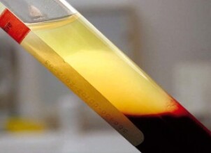 Проведение плазмафереза при беременности и бесплодии