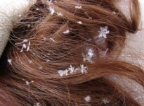 Перхоть при беременности: как от нее избавиться?