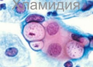 Лечим хламидиоз при беременности