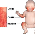 Лечение атопического дерматита