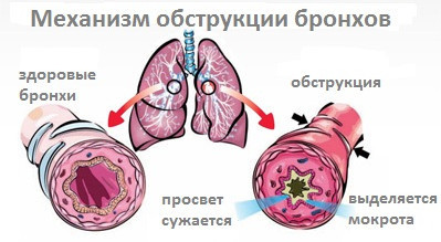 Лечение бронхита