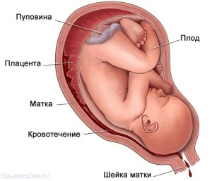 Отслойка плаценты