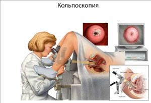 Кольпоскопия при беременности