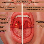 Ангина