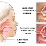 Ларингит