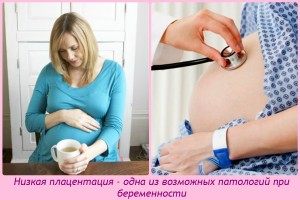 Низкая плацентация при беременности