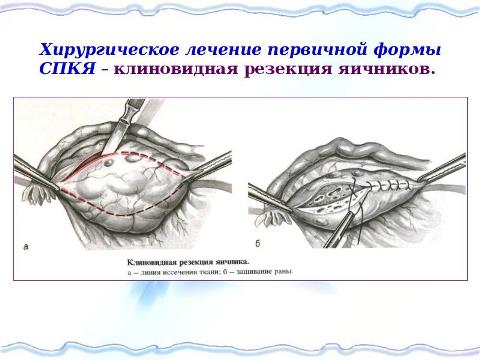 беременность при поликистозе