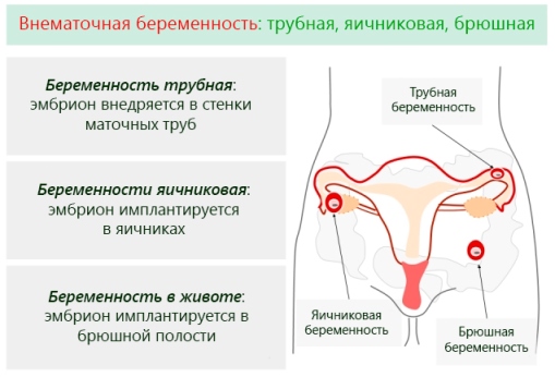 брюшная беременность