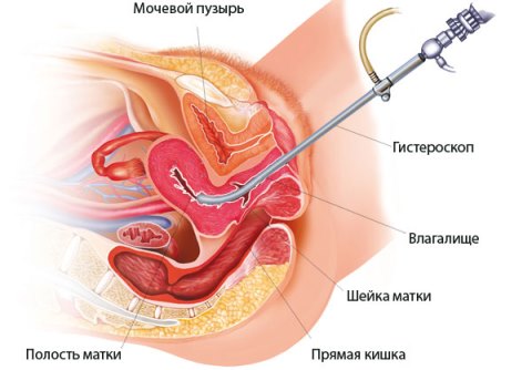 проведение гистероскопии